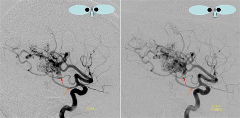 anterior choroidal plexus angiograph